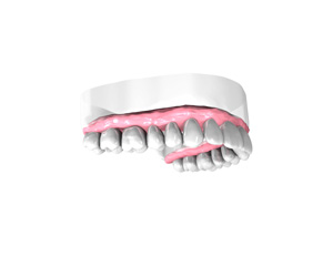 Couronne dentaire sur implant