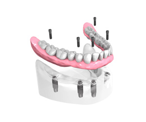 Dentier fixé sur 6 Implants Dentaires