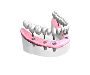 Bridge céramique Comlet sur Implants Dentaires
