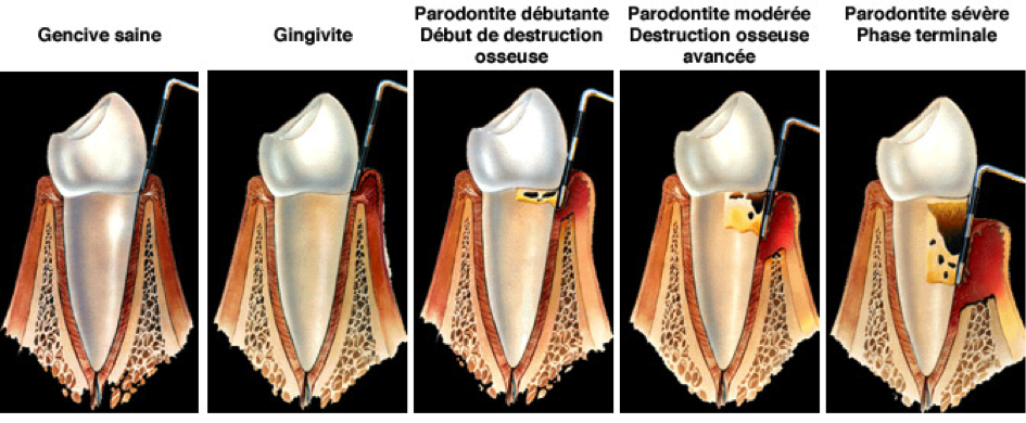 La maladie parodontale